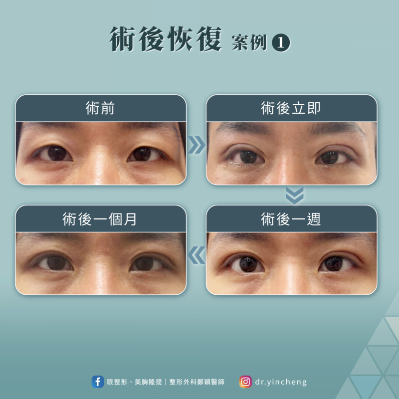 雙眼皮手術術後恢復案例1 雙眼皮手術 恢復案例