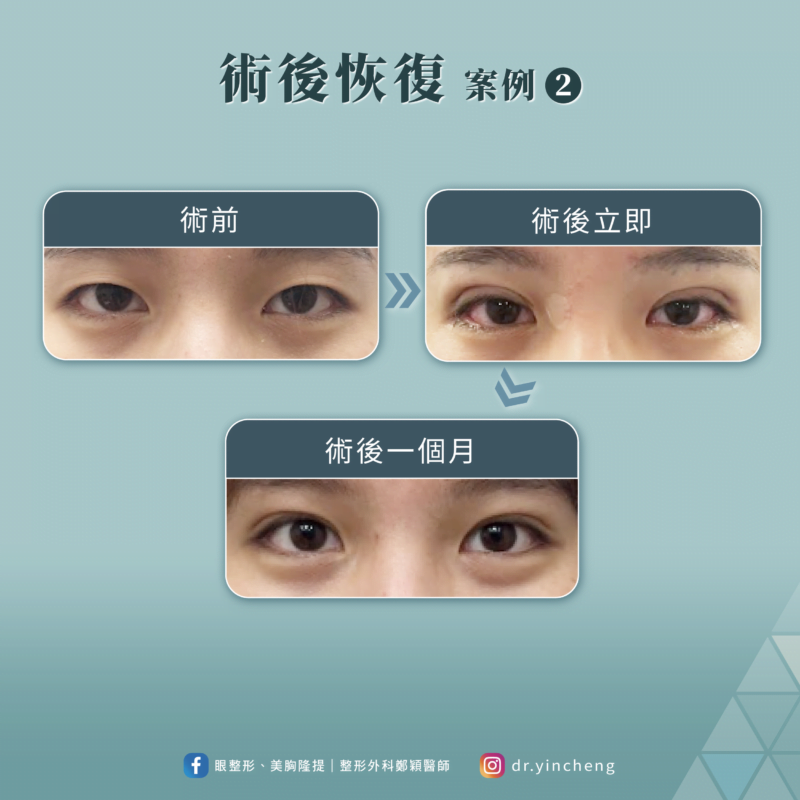 雙眼皮手術術後恢復案例2 雙眼皮手術 恢復案例