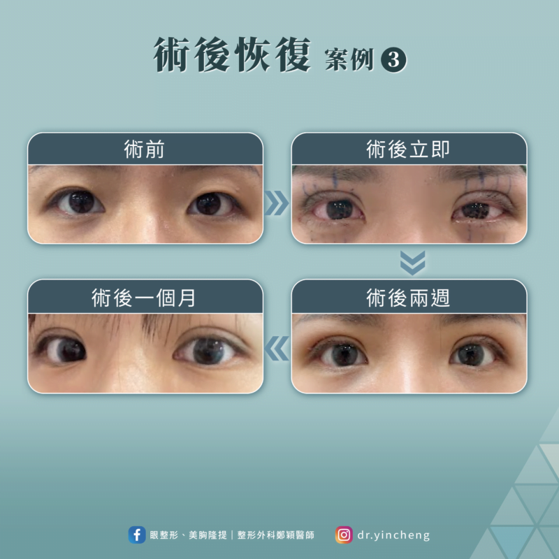 雙眼皮手術術後恢復案例3 雙眼皮手術 恢復案例