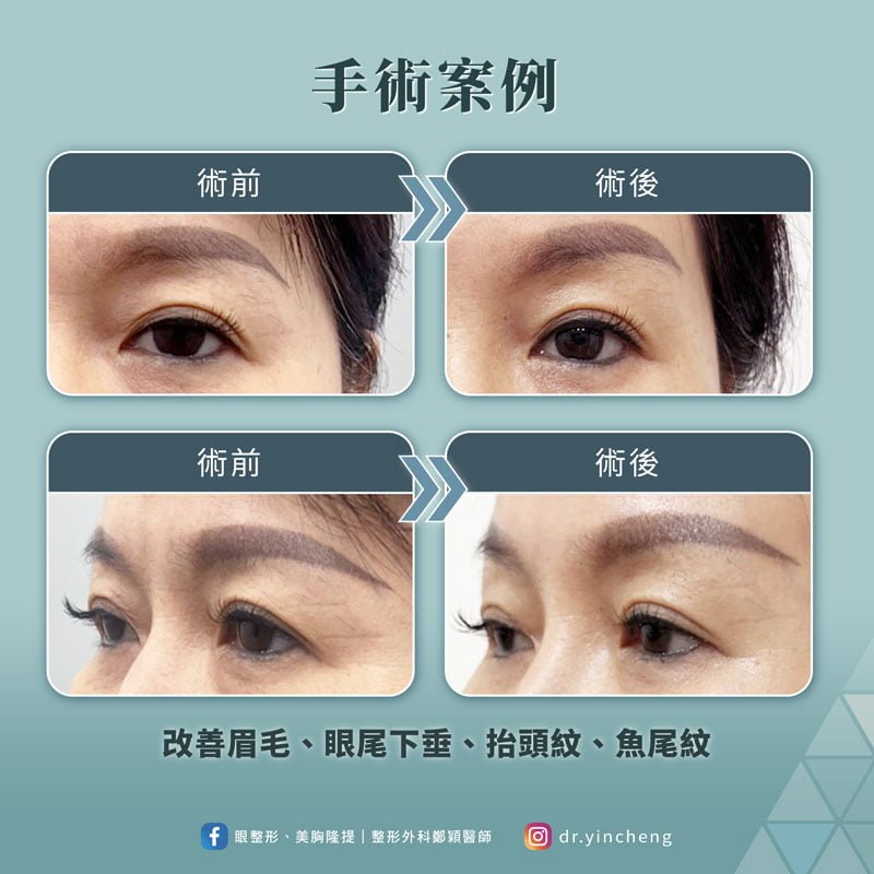 內視鏡前額拉皮手術前後對照圖2