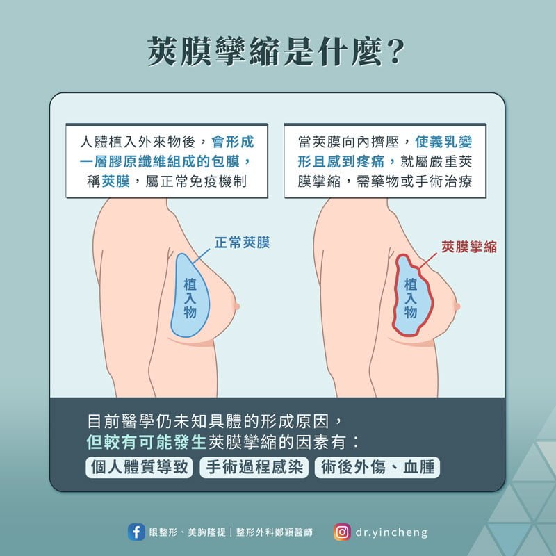 隆乳後的莢膜攣縮是什麼?