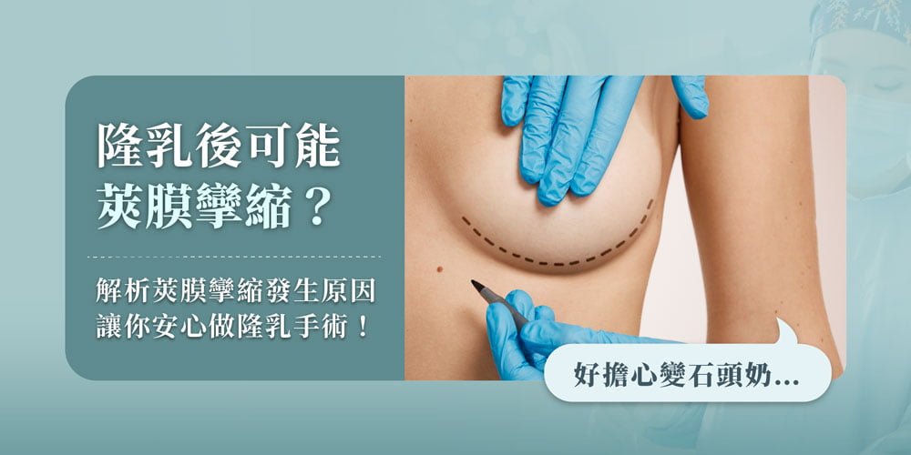 隆乳後的莢膜攣縮是什麼?解析莢膜攣縮發生原因,讓你安心做隆乳手術!
