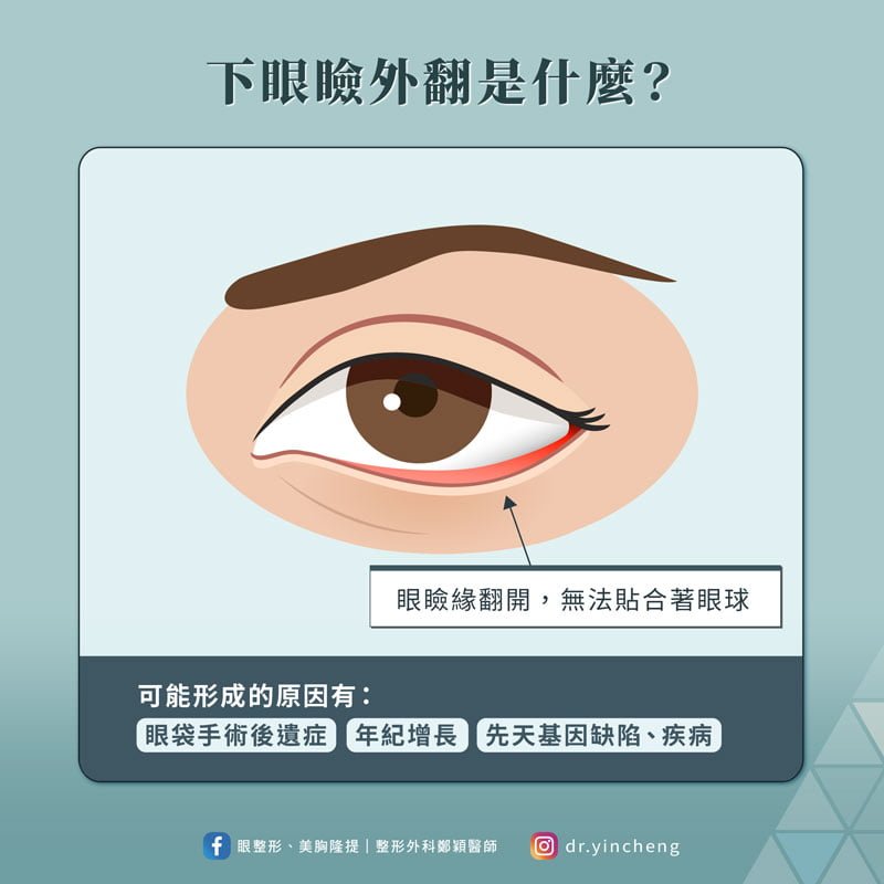 下眼瞼外翻是什麼? 下眼瞼外翻是什麼?