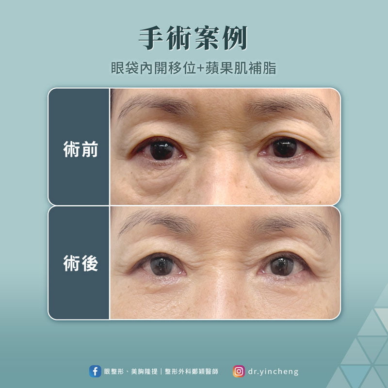 無痕眼袋內開+蘋果肌補脂案例 無痕眼袋內開移位+蘋果肌補脂