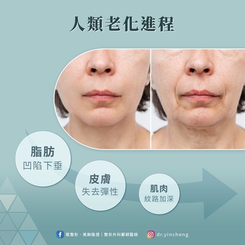人的老化表現有:脂肪下垂、皮膚失去彈性、肌肉紋路加深等象徵出現