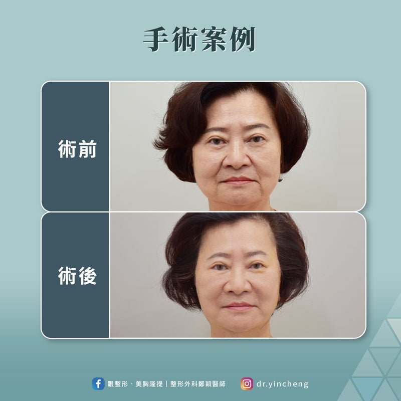 中下臉拉皮手個案術前術後照片