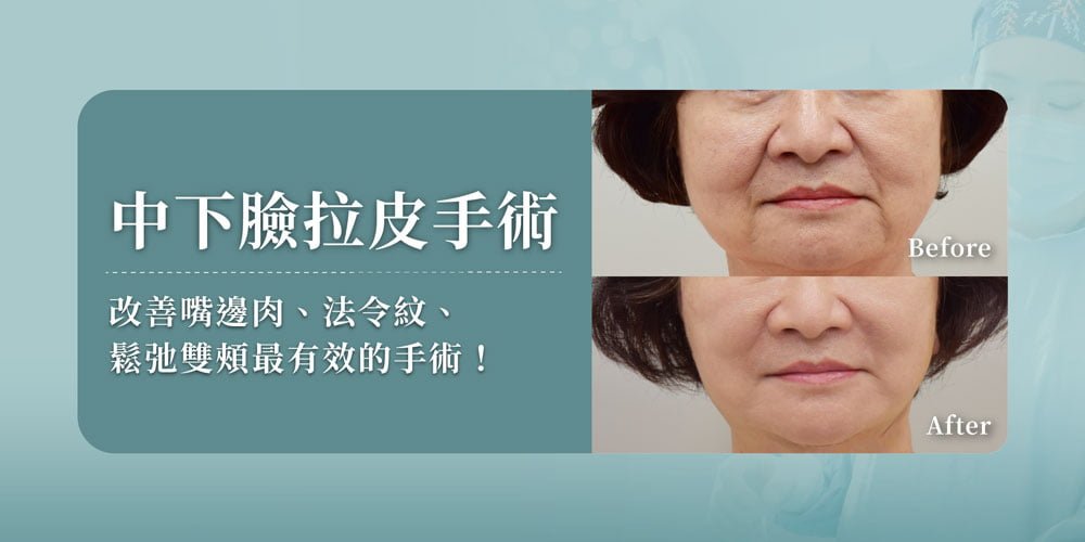 中下臉拉皮手術—改善嘴邊肉、法令紋、鬆弛雙頰最有效的手術!