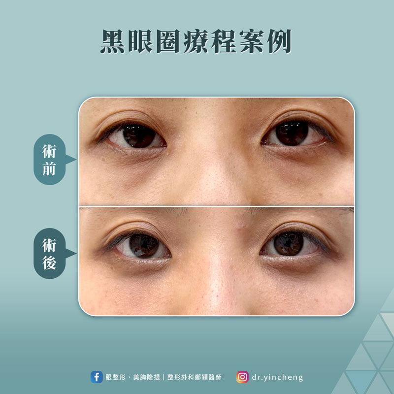 黑眼圈療程個案術前術後比較圖