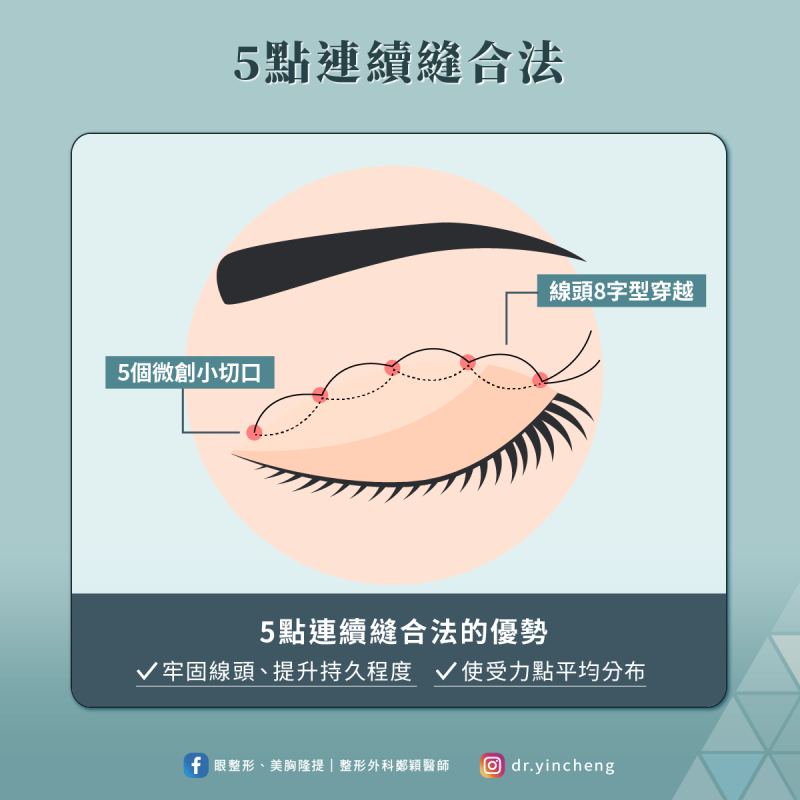 縫雙眼皮手術-5點連續縫合法,可牢固線頭,提升持久程度