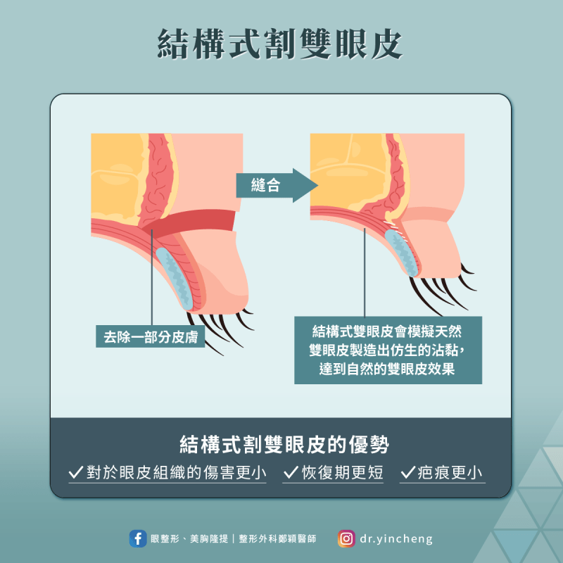 結構式割雙眼皮-微創小傷口可加快術後恢復、疤痕更隱形
